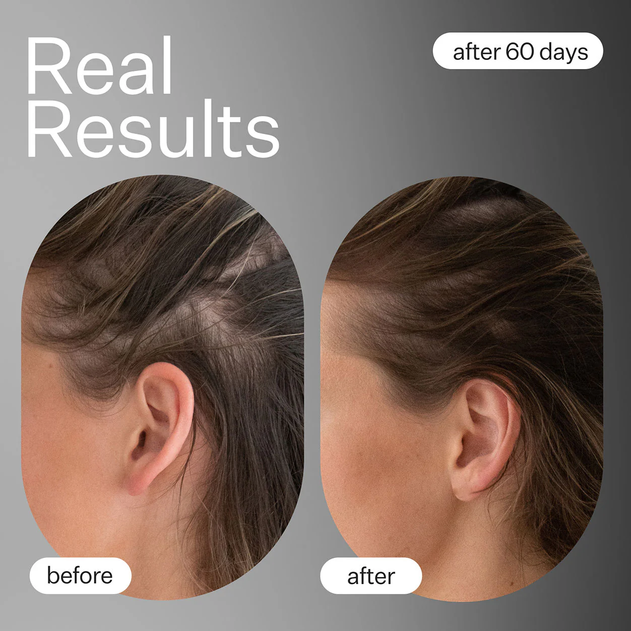 Dermaroller Hair System - Image 2