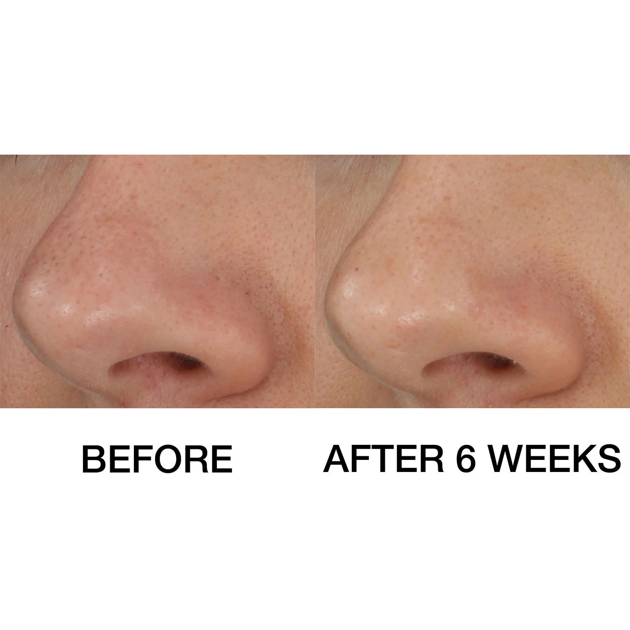 Blackhead Solutions Self-Heating Blackhead Extractor - Image 4