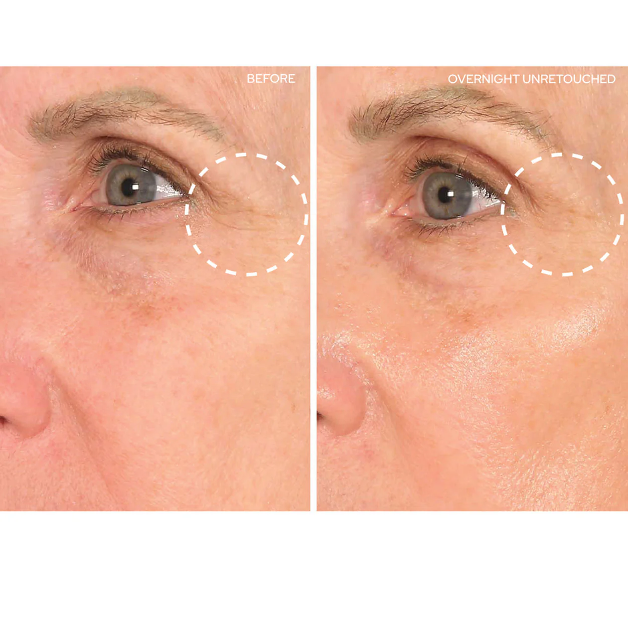 Eye and Smile Lift - Image 6